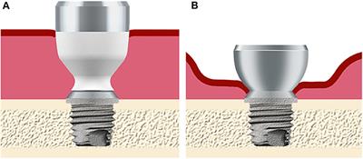 Clinical Outcomes of Soft Tissue Preservation Surgery With Hydroxyapatite-Coated Abutments Compared to Traditional Percutaneous Bone Conduction Hearing Implant Surgery—A Pragmatic Multi-Center Randomized Controlled Trial